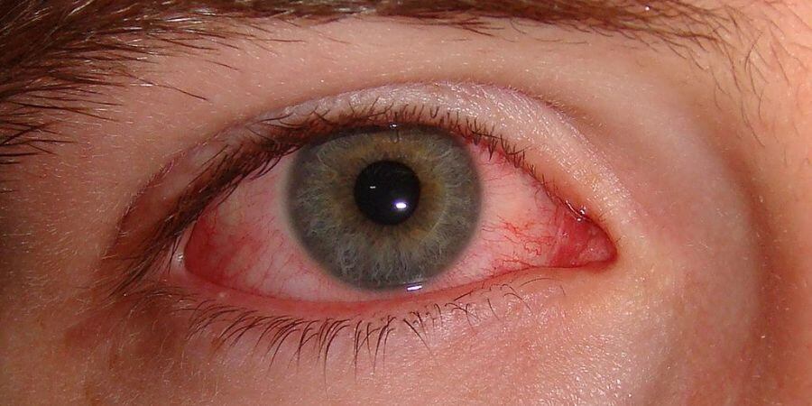 Closeup of a red eye with pink eye