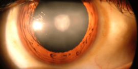 Closeup of an eye with a cataract