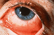 Example of Conjunctivitis