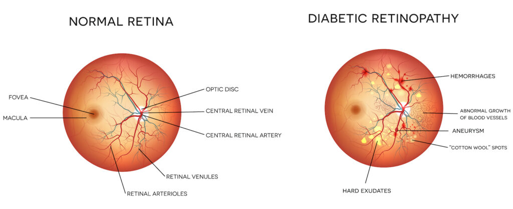 Diabetic retinopathy and normal eye retina.