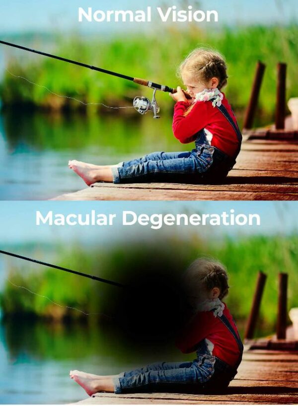Normal vision vs macular degeneration