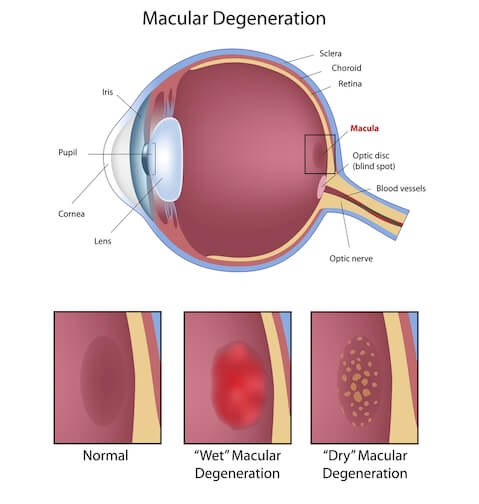 Types of Macular Degeneration. Wet and Dry.