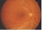 A billowing retinal detachment surrounds the macula.