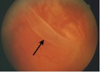 The retinal tear (arrow) causing this detachment is seen in the inferior retinal periphery.