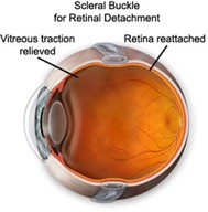 scleral_buckle